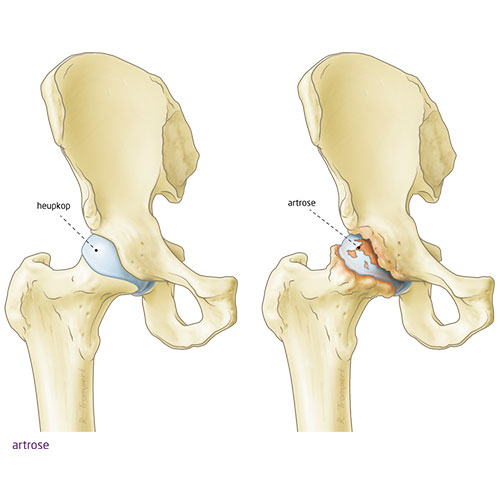 Promoten kooi Voorstad Wat is Heupartrose (Coxartrose)? - My Medical Centre